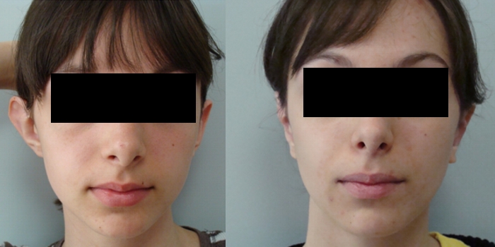 Otoplasty, after 7  days